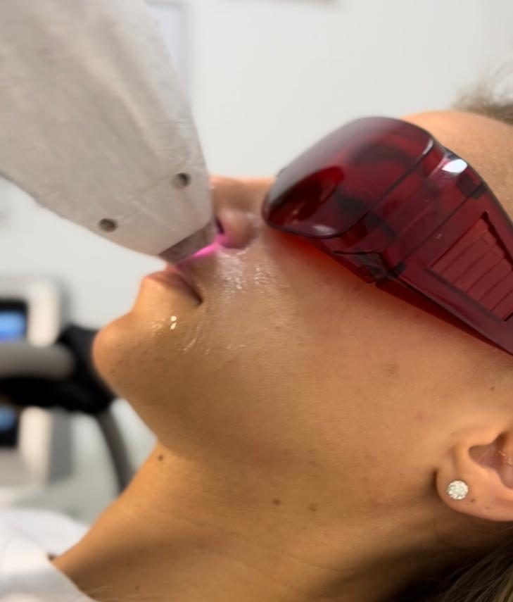 Epilare laser mustata