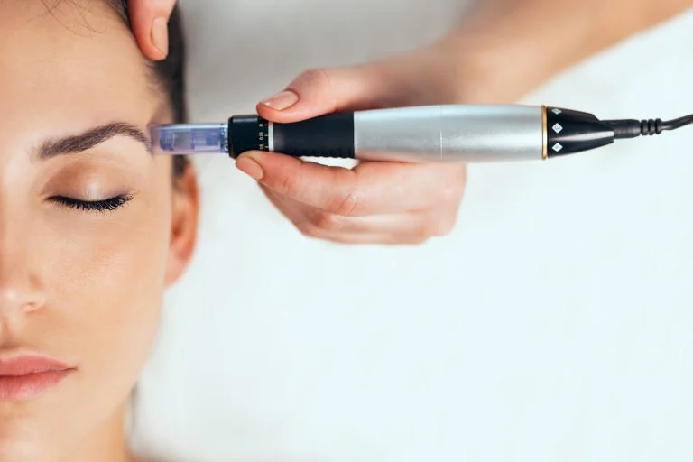 Microneedling bistrita